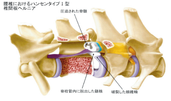 腰椎におけるハンセンタイプ
